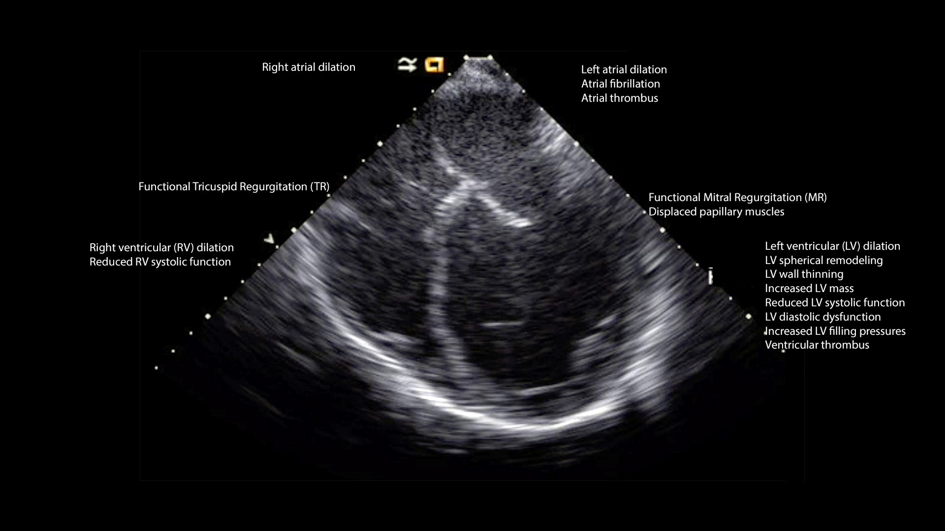 Echocardiogram in left ventricular systolic dysfunction 