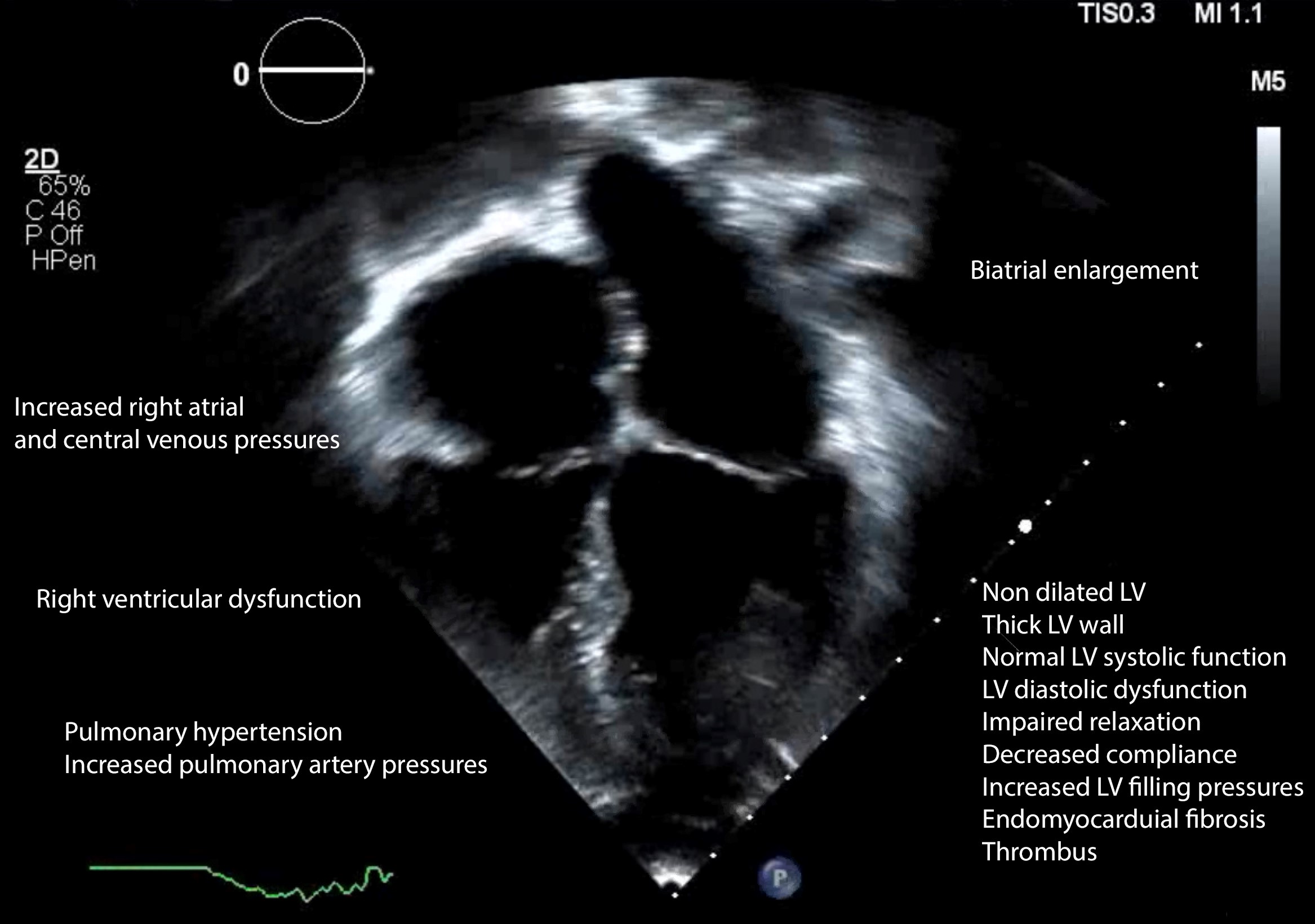 Figure 3. Echocardiographic features of restrictive cardiomyopathy