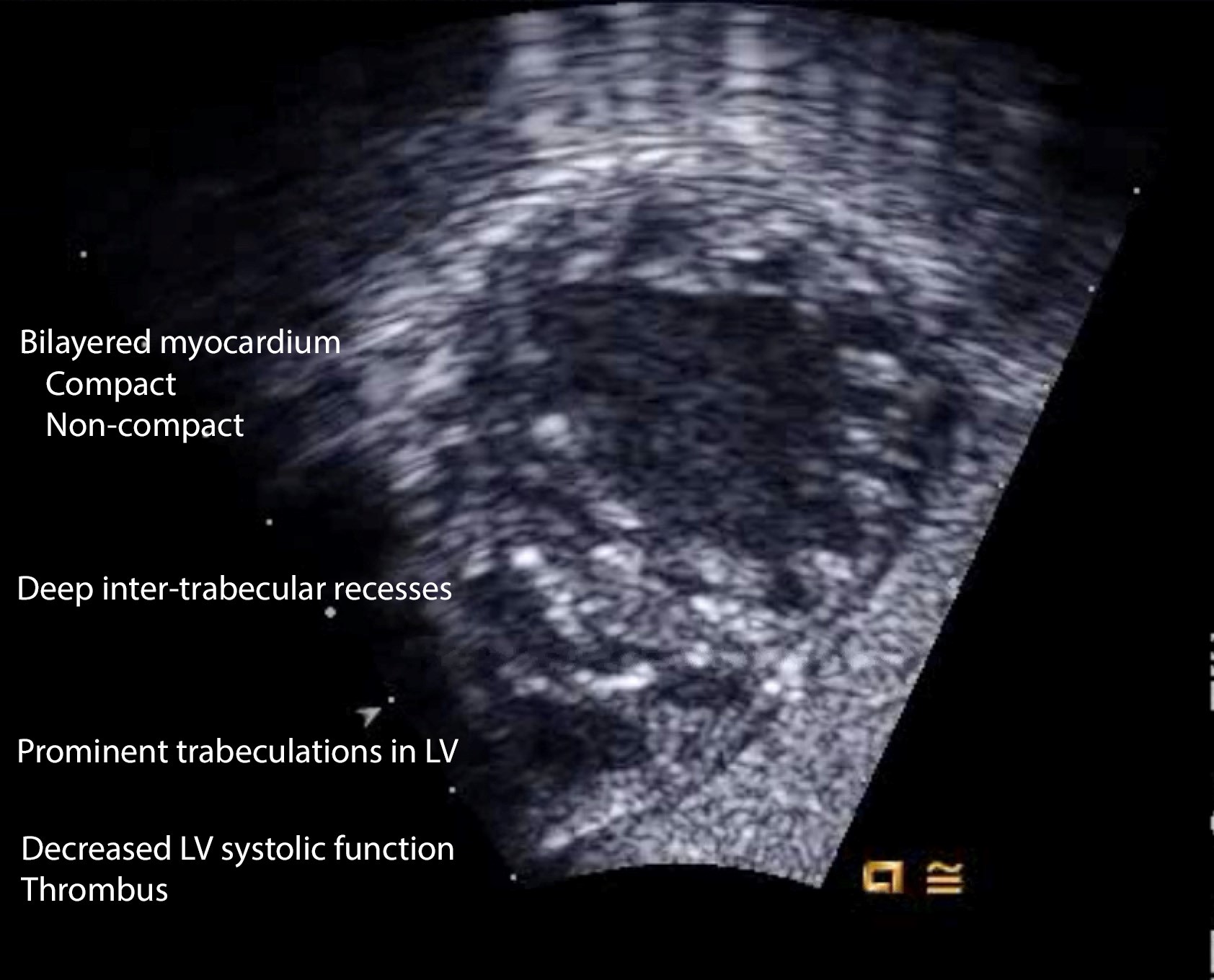 Figure 4. Echocardiographic features of non-compaction cardiomyopathy